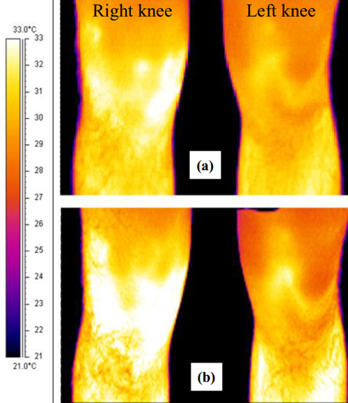 右膝OA运动员比赛前后左右膝盖的红外热成像
